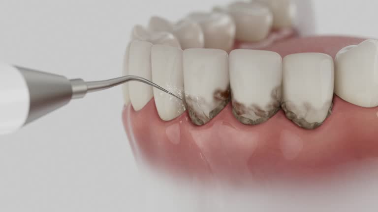 Reliable Tooth Extraction contractor in Miramar, FL by Smile Center Dentistry